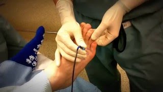 Radiofrequency Ablation For Painful Neuroma [upl. by Emiatej899]