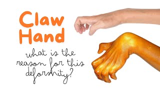 Claw hand is due to paralysis of what muscles Reason for clawing of hand handdeformity clawhand [upl. by Latsryc]