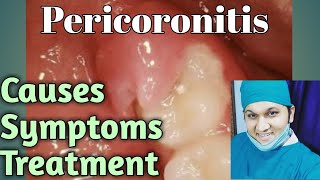 Pericoronitis Types Causes Signs Symptoms Treatments [upl. by Ecarg]