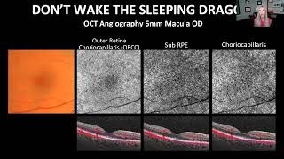 Mastering OCT Interpretation Through Case Analysis [upl. by Island]