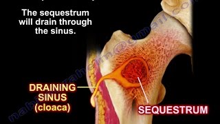 Bone Infection Osteomyelitis Briefly  Everything You Need To Know  Dr Nabil Ebraheim [upl. by Ahsinal258]