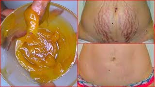 REMOVE STRETCH MARKS FAST HOW TO GET RID OF STRETCH MARKS EFFECTIVELY  Khichi Beauty [upl. by Brander]