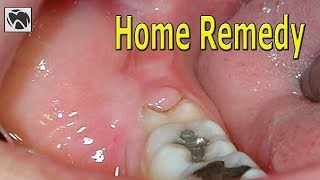 Pericoronitis Home Remedy  Best Pericoronitis Treatment at Home  Wisdom Teeth [upl. by Nylodnarb]