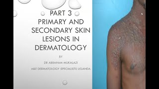 PRIMARY AND SECONDARY SKIN LESIONS CONFIGURATION AND DISTRIBUTION OF SKIN DISEASESeducation duet [upl. by Echikson]