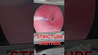 How stricture urethra look urethralstricturetreatment urethralstricture strictureurethra [upl. by Darrow]