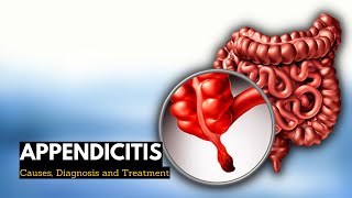 Appendicitis Causes Signs and Symptoms Diagnosis and Treatment [upl. by Adimra27]