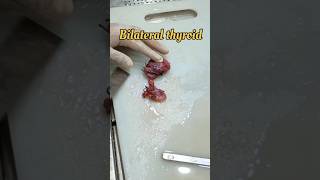 Bilateral thyroid gland specimen 🧐 [upl. by Cherry689]