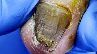 Pedicure Tutorial：Huge toenail trimming，severe onychomycosis【Pedicure Master Lin Jun】 [upl. by Mcneil]