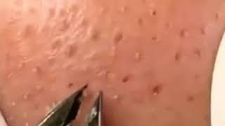 BLACKHEADS PULLING BY TWEEZERS [upl. by Akinimod]