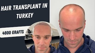 Hair Transplant Before and After Operation  4800 Grafts Hair Transplant  Hair Transplant in Turkey [upl. by Ilatfan]