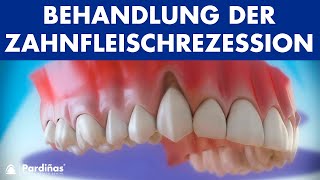 Zahnfleischrückgang – Behandlung der Zahnfleischrezession © [upl. by Casta690]