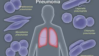 Treating CommunityAcquired Pneumonia [upl. by Sirovart]