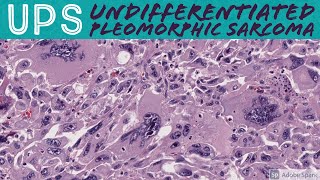 Undifferentiated Pleomorphic Sarcoma 101 UPS formerly malignant fibrous histiocytomaMFH [upl. by Neehsas93]