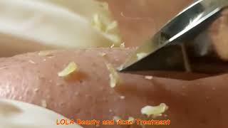 Nonstop Plucking of Whiteheads on the Nose with a Tweezer [upl. by Elcin]