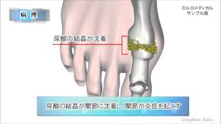 痛風／2分で分かる医療動画辞典 ミルメディカル [upl. by Aitnahc825]