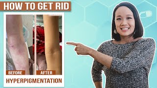 Eczema Hyperpigmentation and Hypopigmentation Solutions amp Treatments [upl. by Brig]