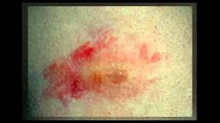 Stages Of Shingles Rash [upl. by Elatsyrc]