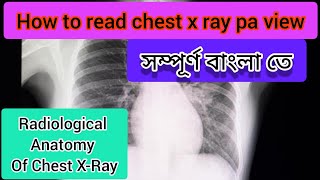 How To Read Chest XRay PA viewChest x ray radiological anatomy [upl. by Groh]