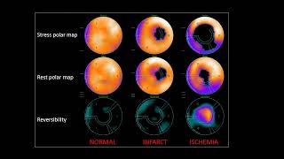 Nucradsharewordpresscom HOW TO READ MYOCARDIAL PERFUSION SCAN [upl. by Ahsiym841]