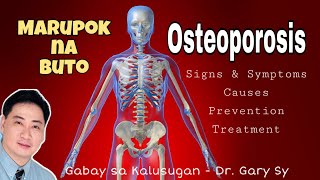 Osteoporosis  Dr Gary Sy [upl. by Ttelracs]