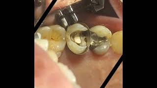 Pulpotec Retreatmentالكربولة endodontics [upl. by Czarra331]