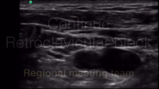 Continue Retroclavicular Brachial Plexus block [upl. by Neenej]