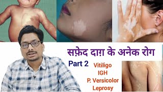 सफ़ेद दाग़ के अनेक रोग  Part 2  White Spots in Adults amp Elderly  Vitiligo IGH P versicolor Leprosy [upl. by Atteugram697]