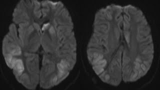 Case discussion Transient PostIctal MRI changes [upl. by Arika639]