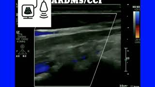 Subclavian Steal Syndrome [upl. by Ettennig]