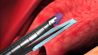 Animation Endo GIA™ Reinforced Reload with Tri Staple™ Technology Chapter 3 orSo6xtt1DI [upl. by Alegnasor]