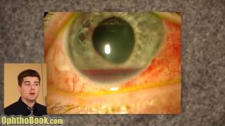 Exploding Eye Lecture [upl. by Specht]