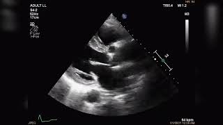 Systolic function assessement by ETT  Avaliação da função sistólica por ETT [upl. by Enisaj]