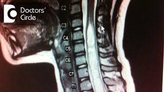 How to manage Syringomyelia in 45 year old  Dr Mohan M R [upl. by Eenor702]