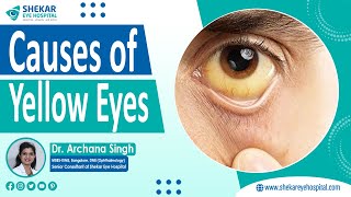 Causes of Yellow Eyes  Yellow Eyes Treatment in Bangalore  Shekar Eye Hospital [upl. by Chrissy]