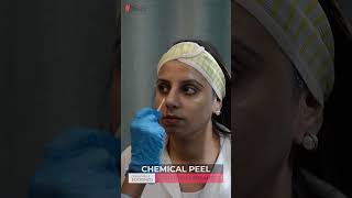 Chemical Peel For Active Acne amp Scars  HASH CLINICS [upl. by Noynek]