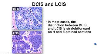 A Practical Approach to Surgical Pathology Volume VIII  A Video CME Teaching Activity [upl. by Ailugram]