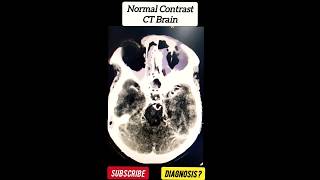 Normal Contrast CT Brain  Radiology [upl. by Nor]