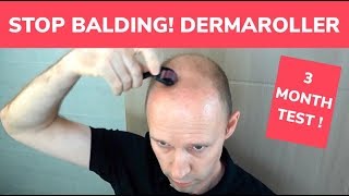 STOP BALDING  Dermaroller 3 Month Test and Tutorial [upl. by Enreval]