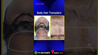 Hair Transplant by Body Hair BHT explained by Dr Suneet Soni at Medispa Hair Transplant India [upl. by Hamitaf]