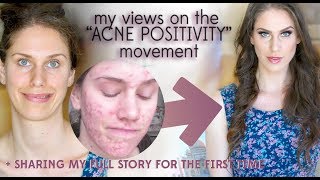 What I Really Think Of quotACNE POSITIVITYquot Sharing My Full Emotional Acne Story GRWM Acne Awareness [upl. by Scott]