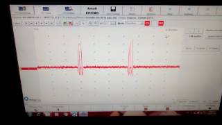 EMG recording sharing brief discharges consistent with myokymia JNSK [upl. by Menzies978]