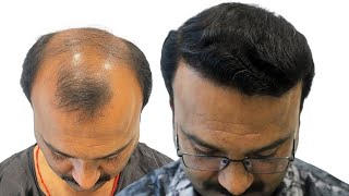 Remarkable Transformation See the Results of 5000 Grafts for Grade 6 Baldness After 7 Months [upl. by Nyleuqcaj]