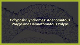 Polyposis Syndromes Adenomatous Polyps and Hamartomatous Polyps [upl. by Rodie909]