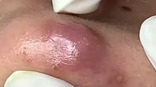 Blackheads Removal  Acne Treatment and Very Satisfying Satisfying Pimple pop blackheads [upl. by Turtle803]