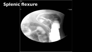 Barium Enema Double Contrast Fluoro  Step by Step Instructions [upl. by Lesna]