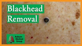 Blackhead Removal without Extractor Tool Edited  Auburn Medical Group [upl. by Morgun737]