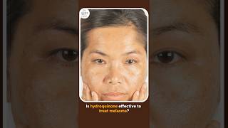 Is Hydroquinone Safe amp Effective for Melasma [upl. by Haff]