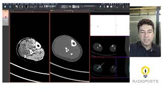 DISCUSSÃO DE CASO  Sarcoma  Tomografia  Cintilografia Óssea  SPECTCT [upl. by Nednil155]