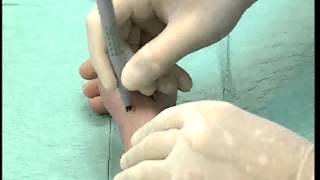 Dr Jarghon  Gaza Strip  Radial Nerve Block At The Wrist [upl. by Ulphi]