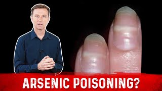 Identify Arsenic Poisoning Through Your Nails [upl. by Aztinad]